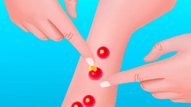 Pimple Poper Rush game thumbnail